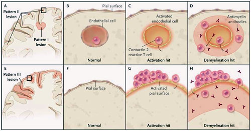 Figura 1: modelo de formación de la lesión en la esclerosis múltiple