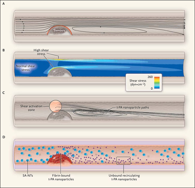 Figura 1: características positivas del flujo de la estenosis
