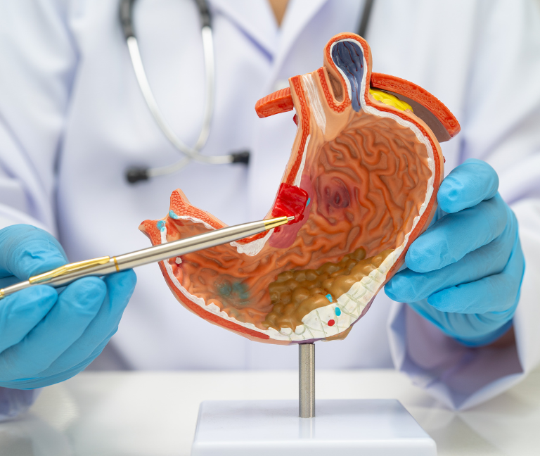 Panorama del cáncer gástrico