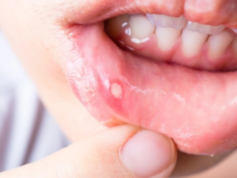 Herpangina, pblación pediátrica, enterovirus