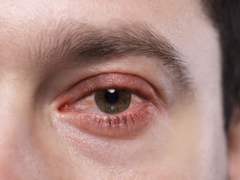 alergias oculares, picazón ocular, enrojecimiento ocular, enfermedad alérgica ocular, conjuntivitis alérgica, conjuntivitis alérgica estacional, conjuntivitis alérgica perenne, queratoconjuntivitis vernal, olopatadina