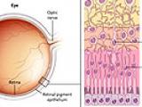 Mejorando la visión en la retinitis pigmentaria