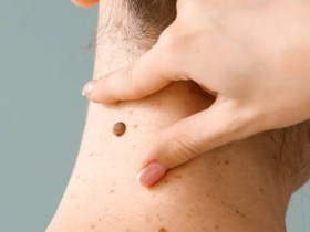 cáncer de piel, lesiones cutáneas, lunares, día mundial cáncer de piel