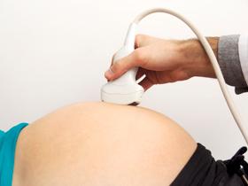 Diabetes mellitus gestacional predice una aterosclerosis temprana