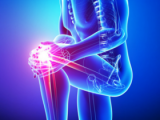 Acupuntura retrasa uso de opioides tras artroplastía