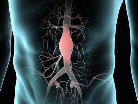 Metformina podría limitar el aneurisma aórtico abdominal