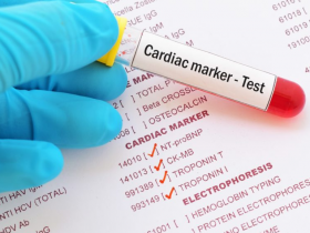 Biomarcadores identifican gradiente de riesgo tras SCA