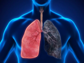 Terapia combinada es efectiva en el adenocarcinoma pulmonar