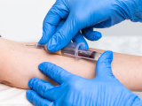 Prueba de sangre para la detección temprana del cáncer colorrectal