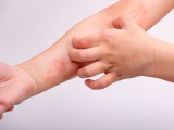 Dermatitis atópica, una puerta a enfermedades autoinmunes