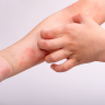 Dermatitis atópica, una puerta a enfermedades autoinmunes
