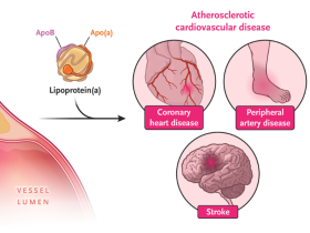 colesterol de lipoproteínas de baja densidad, LDL-C, colesterol LDL, hipercolesterolemia, prevención de la enfermedad cardiovascular aterosclerótica, aterosclerosis, edición de bases de ADN in vivo